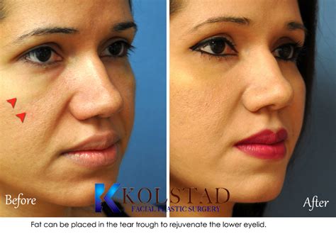 Facial Fat Transfer Before & After Gallery - Dr. Kolstad - San Diego ...