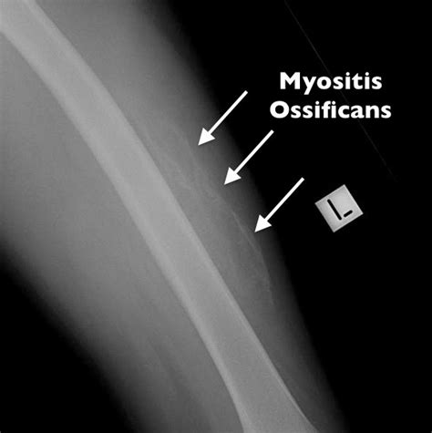 What Exactly is Myositis Ossificans?