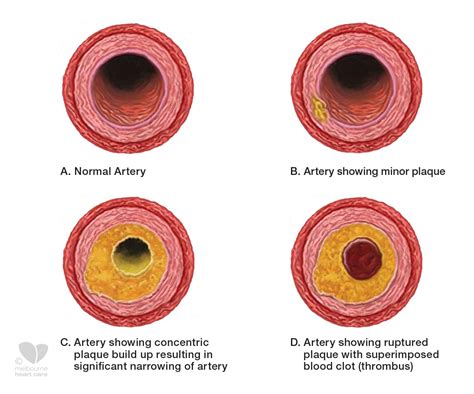 What Causes Plaque Buildup In Heart Arteries at Edwin Williams blog