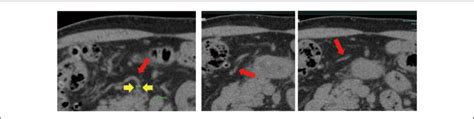 Measuring the right gastroepiploic artery (GEA) on computed tomography ...