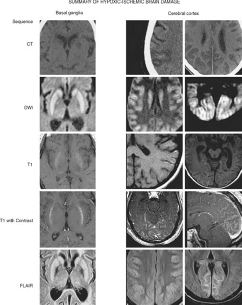 Hypoxic-Ischemic Brain Damage | Radiology Key