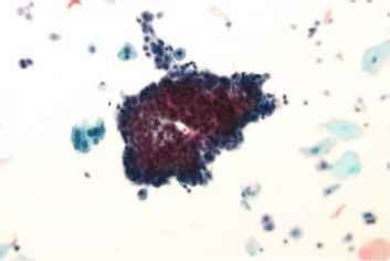 Atypical Urothelial Cells Indeterminate for Neoplasia - Urothelial Cells