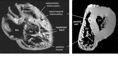 [PDF] Double-chambered right ventricle or sub-infundibular stenosis assessed by cardiovascular ...