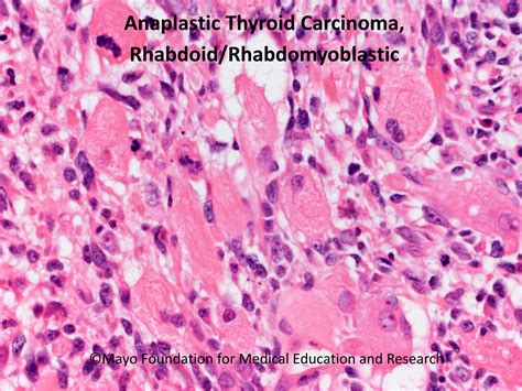 Anaplastic Thyroid Carcinoma - Mayo Clinic Proceedings