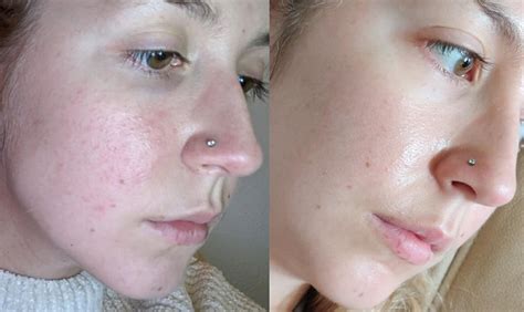 [B&A] Amazing progress in just one week of adding TO Azelaic Acid 10% to my routine ...