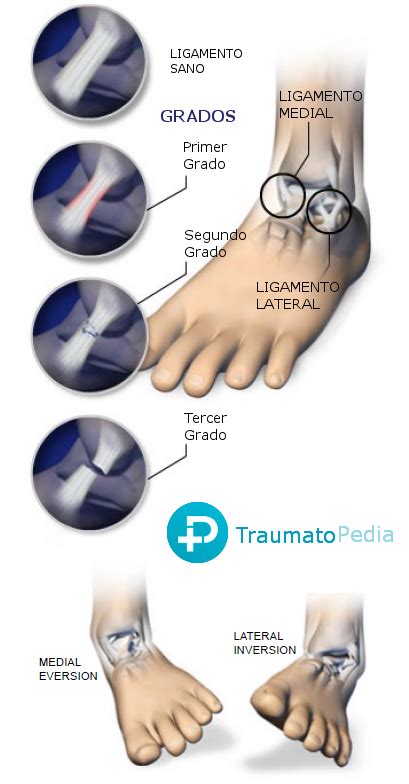 Grados de esguince de tobillo y tratamiento - Traumatopedia