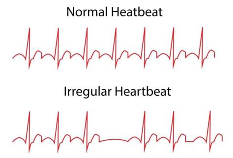 Heart Arrhythmias – Types, Causes and Prevention | Healthtian