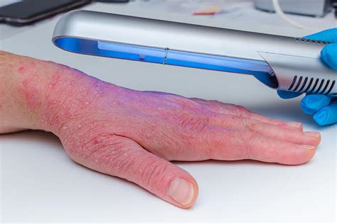 Guideline Addresses Role of Phototherapy in Psoriasis | Medpage Today