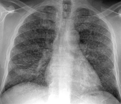 Blastomycosis Lung X Ray