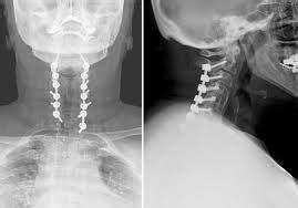 Posterior Cervical Fusion Sunshine Coast | Spinal Deformity Surgery ...