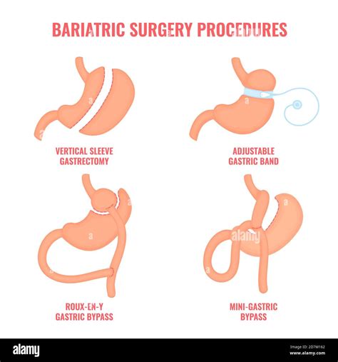 Bariatric surgery types, conceptual illustration. Types of weight loss surgery- gastric bypass ...