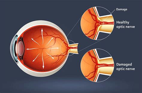 Optic Nerve - All About Vision