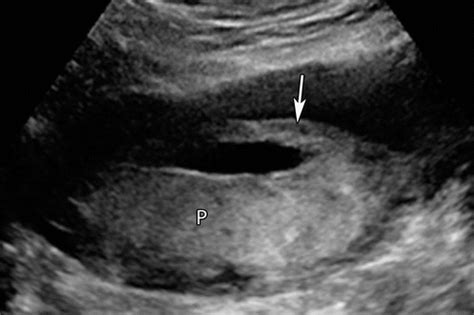 Circummarginate Placenta Ultrasound