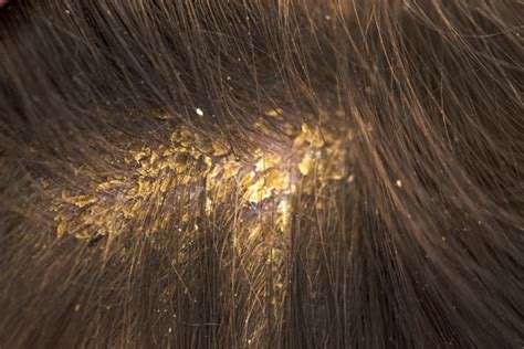 Homeopathic Remedies to Deal with Dandruff | Causes and Symptoms