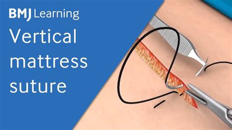 Vertical Mattress Suture | BMJ Learning