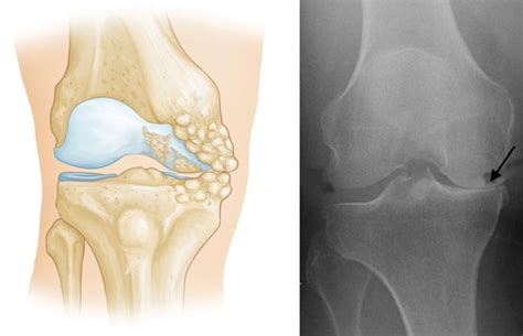 Unicompartmental (Partial) Knee Replacement - OrthoInfo - AAOS