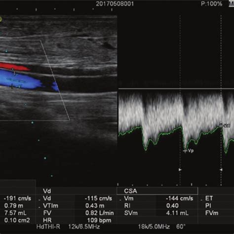 The ultrasound parameters of brachial artery. The sampling area covered ...