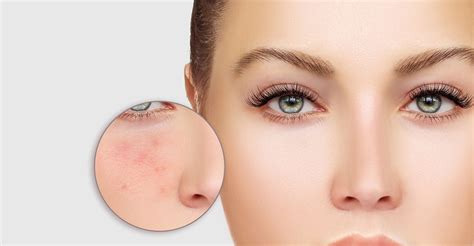 What You Should Know About Acne - Dermatology Associates - Savannah, GA