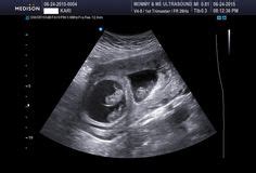 Triplets Ultrasound 19 Weeks | Ultrasound Photos of Twins & Multiples | Triplets, Ultrasound ...