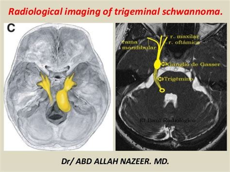 Presentation1, radiological imaging of trigeminal schwanoma.