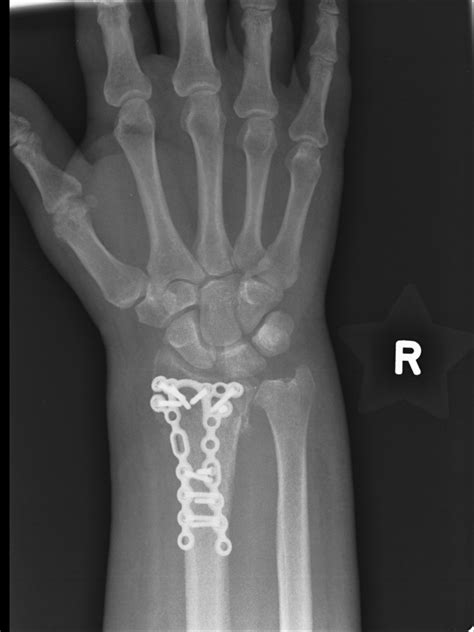 Wrist Fracture Treatment - Manchester Hand & Wrist Surgery