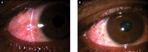 Clinical profile of patients with the first presentation as anterior ...