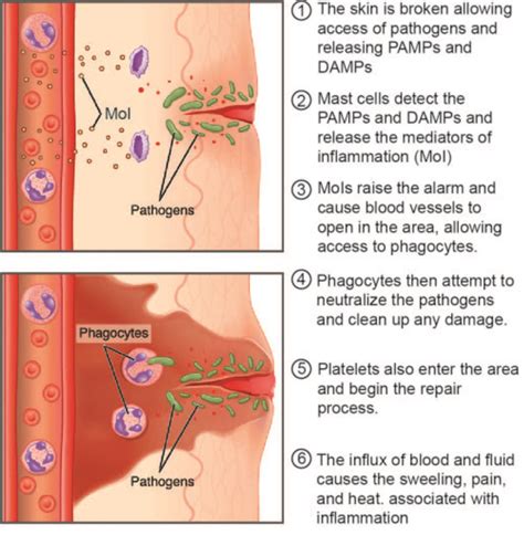 Inflammation Acute and Chronic - Physiopedia