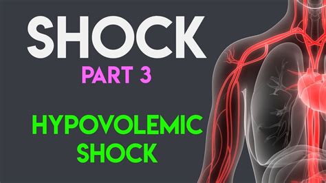 Hypovolemic Shock