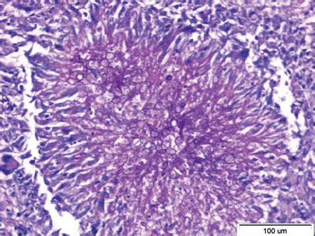 Fungal aggregate in bone tissue (PAS stain). | Download Scientific Diagram