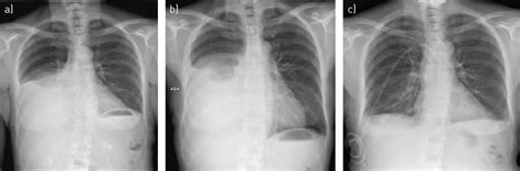 Pleural effusion causes, types, symptoms, diagnosis and treatment