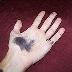 Silver Nitrate Burns - Caustic Soda