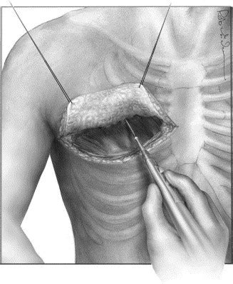 Anterolateral thoracotomy - Operative Techniques in Thoracic and Cardiovascular Surgery