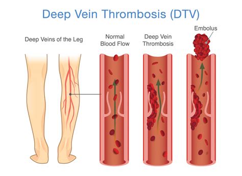 11 Tips for DVT Prevention - Preferred Vascular Group