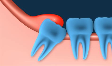 Dealing Pericoronitis with Healthy Dental Tips | D4dentist