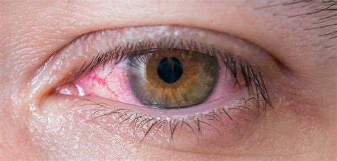 Symptoms of Red Eye and How to Prevent Them | Eye Concepts