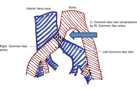 May-Thurner Syndrome: Causes, Symptoms, Treatment and Pictures | Treat ...