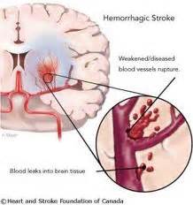 Acute Hemorrhagic Stroke | Society of Vascular and Interventional Neurology