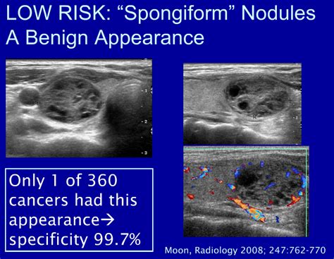 rsna: thyroid and parathyroid US