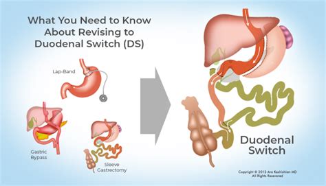 What You Need to Know About Revising to Duodenal Switch (DS) : ObesityHelp