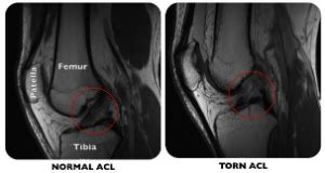 MRI of Normal vs Torn ACL | Fitness inspiration | Pinterest | Acl, Acl tear and Fitness inspiration