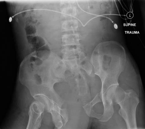 Pelvic Fracture X Ray