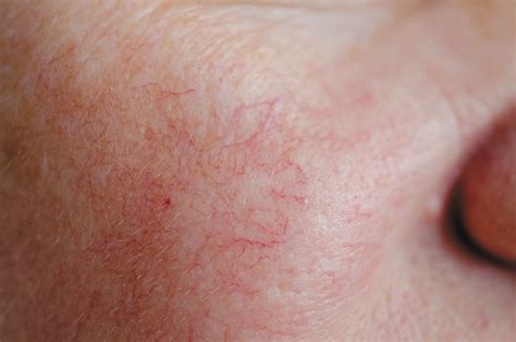 Rosacea can flare at menopause - Harvard Health