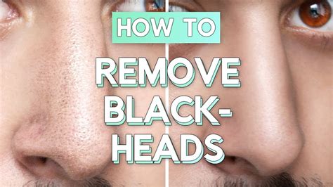 No Bullsh*t Blackhead Removal - How To Remove Blackheads From Face ...