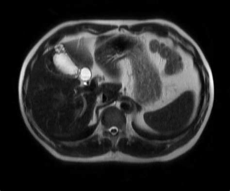 Gallbladder adenomyomatosis | Radiology Case | Radiopaedia.org MRI ...