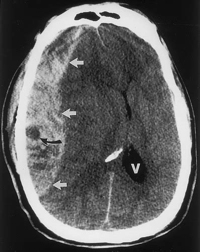 Acute Epidural Hematoma