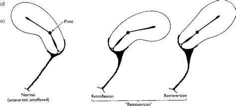 Retroverted Uterus