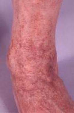 Pigmented Purpuric Dermatosis Clinical Presentation: History, Physical Examination