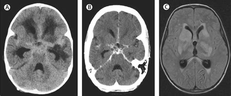 Tuberculous meningitis: a uniform case definition for use in clinical ...