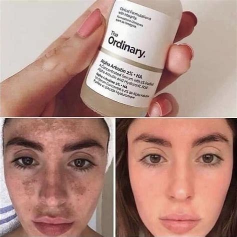 The Ordinary Alpha Arbutin Serum | Skin care, Skin care routine ...