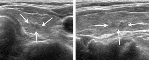 Heterogeneous echogenicity of the underlying thyroid parenchyma: how ...